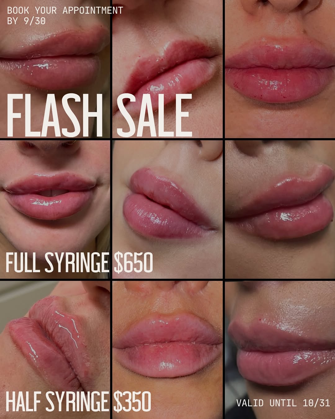 Instagram post by Dr. Frank P. Fechner: Flash Sale 💋 Your sign to finally book the lips. For a limited time: ✨ Full Syringe — $650 ✨ Half Syringe — $350 Book your appointment by 9…