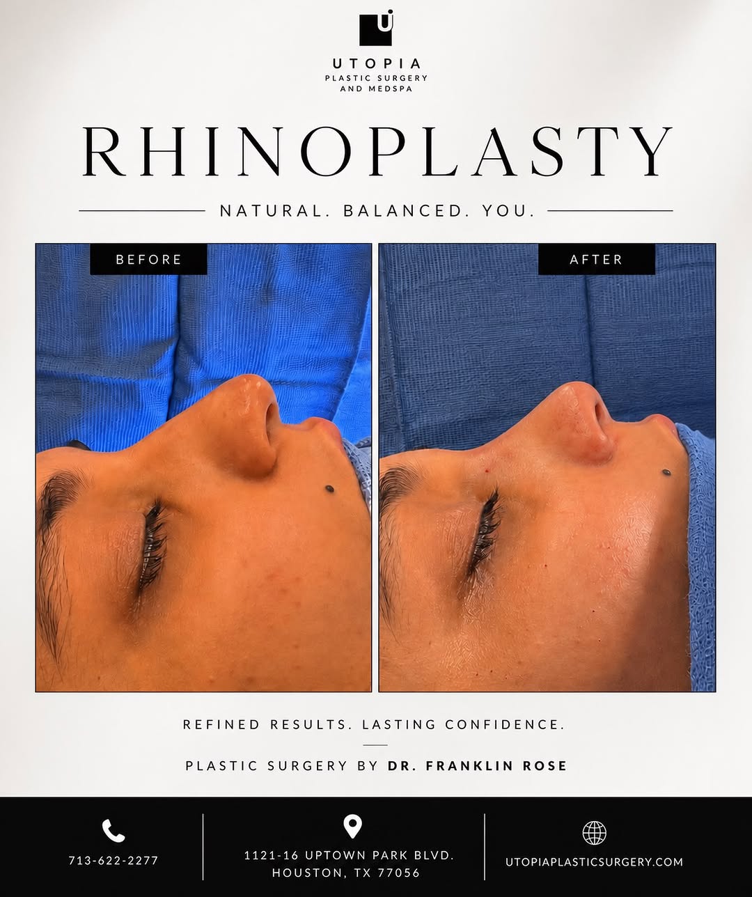 Instagram post by Dr. Franklin A. Rose: A beautifully refined nose should complement your natural features and not define them. ✨ This immediate post-op rhinoplasty result showcase…