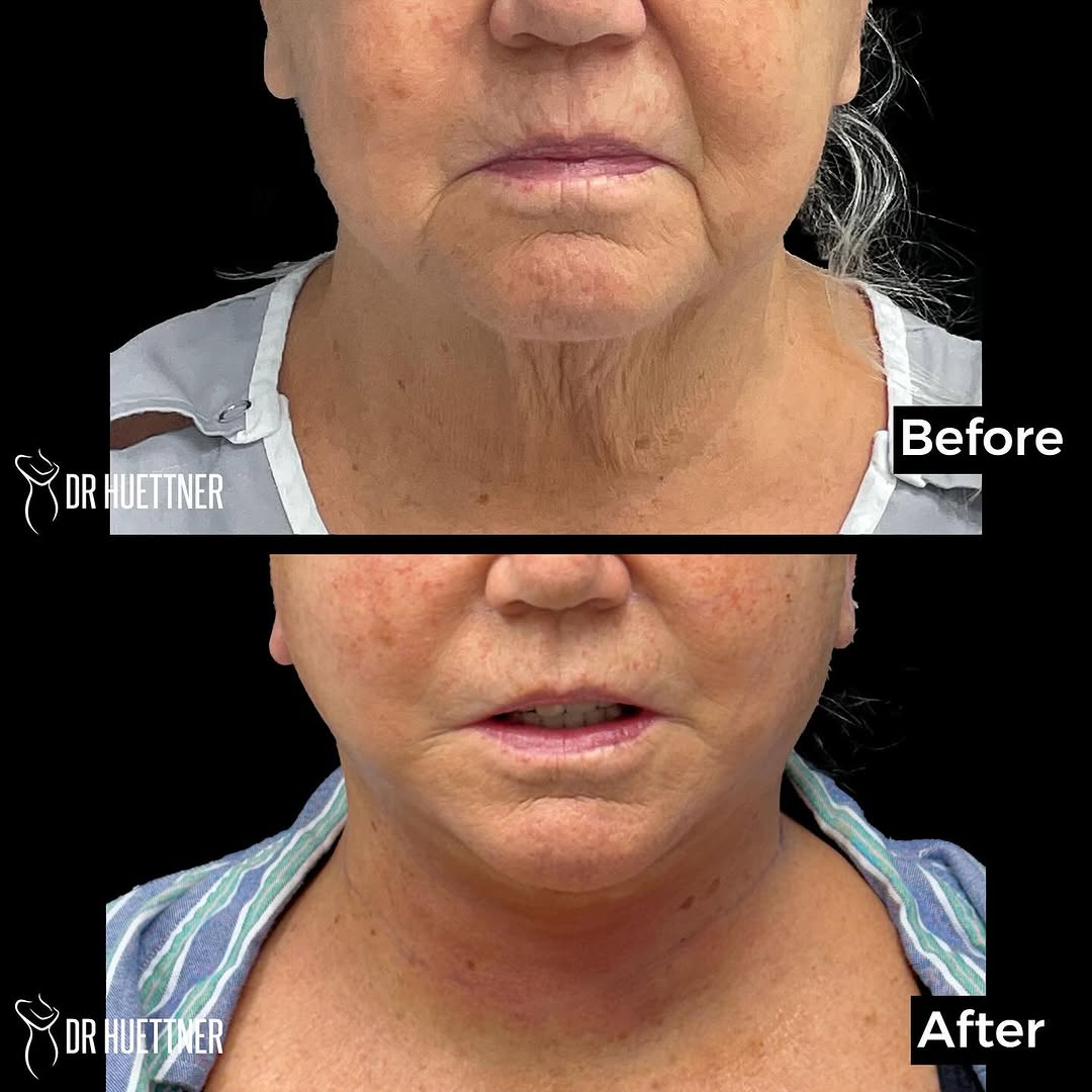 Instagram post by Dr. Franziska Huettner: 1 day after face & neck lift. In office & local anesthesia. Take a look at the neck contour, no more floppy skin. Interested in exploring su…