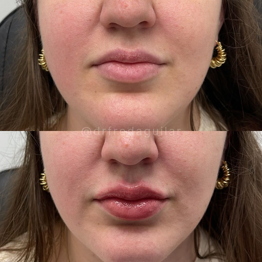 Instagram post by Dr. Fred Aguilar, III: Added some filler to give this patient a more voluminous look. Beautiful result! 👄💉 #lipfiller #fillers #beforeandafter #results