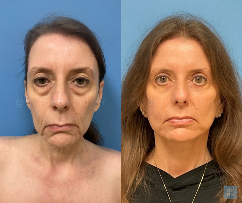 Instagram post by Dr. Fred Aguilar, III: This is a 7 week post-op patient who underwent a Full Face Lift, Neck Lift and Quad Blepharoplasty! She’s still in recovery but what a remar…