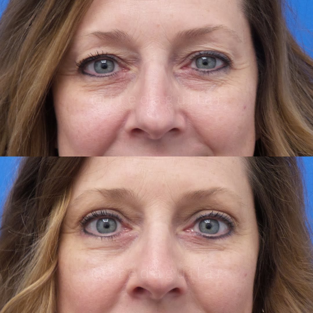 Instagram post by Dr. Fred Aguilar, III: Just one month after blepharoplasty and already a more refreshed look! Call my office at 📲 713-521-4777 to schedule a consultation. 📍1801 …