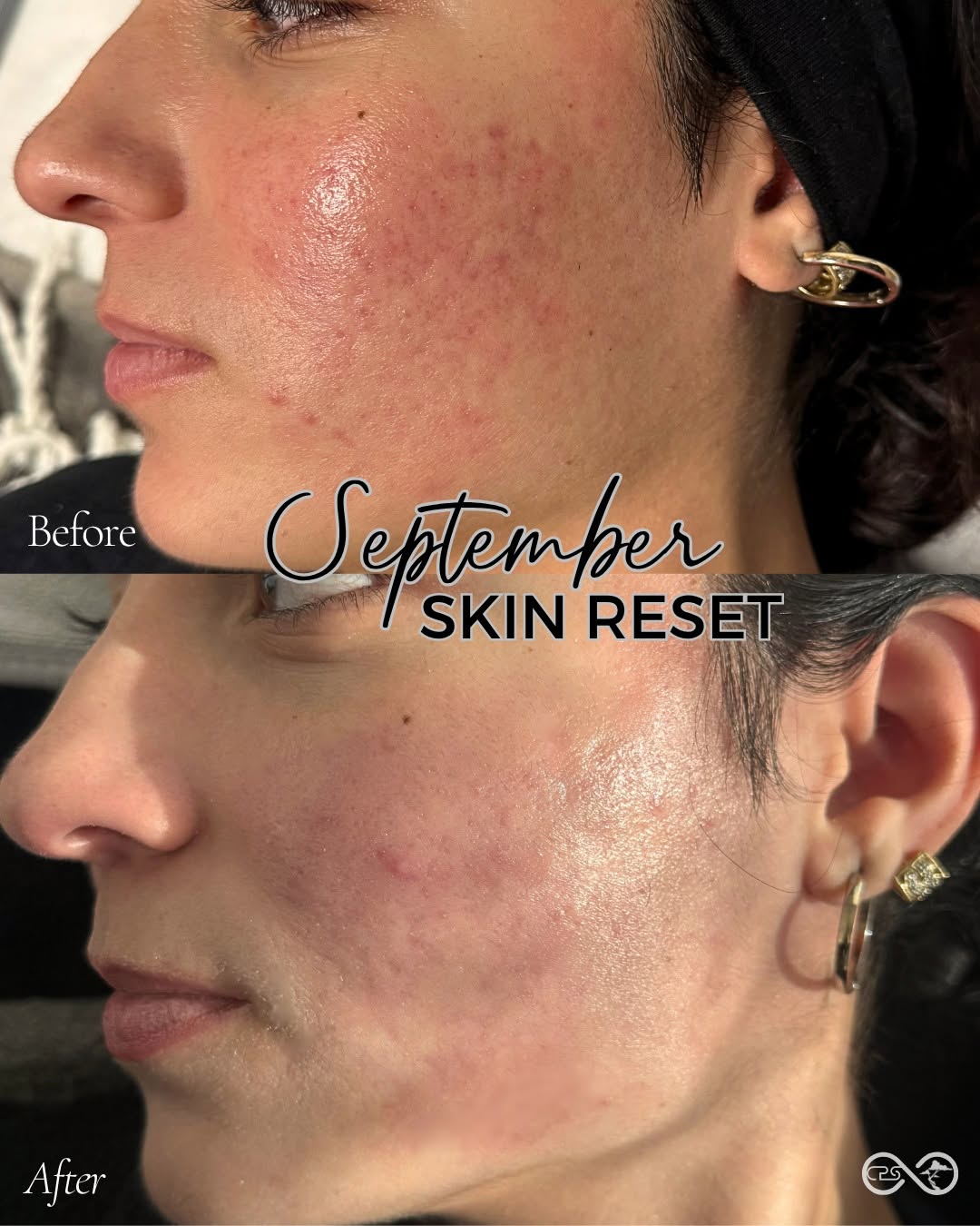 Instagram post by Dr. Frederick A. Coville: September is the perfect time to reset, restore, and redress your skin after summer. ✨ From sun damage and uneven tone to dryness, texture, …