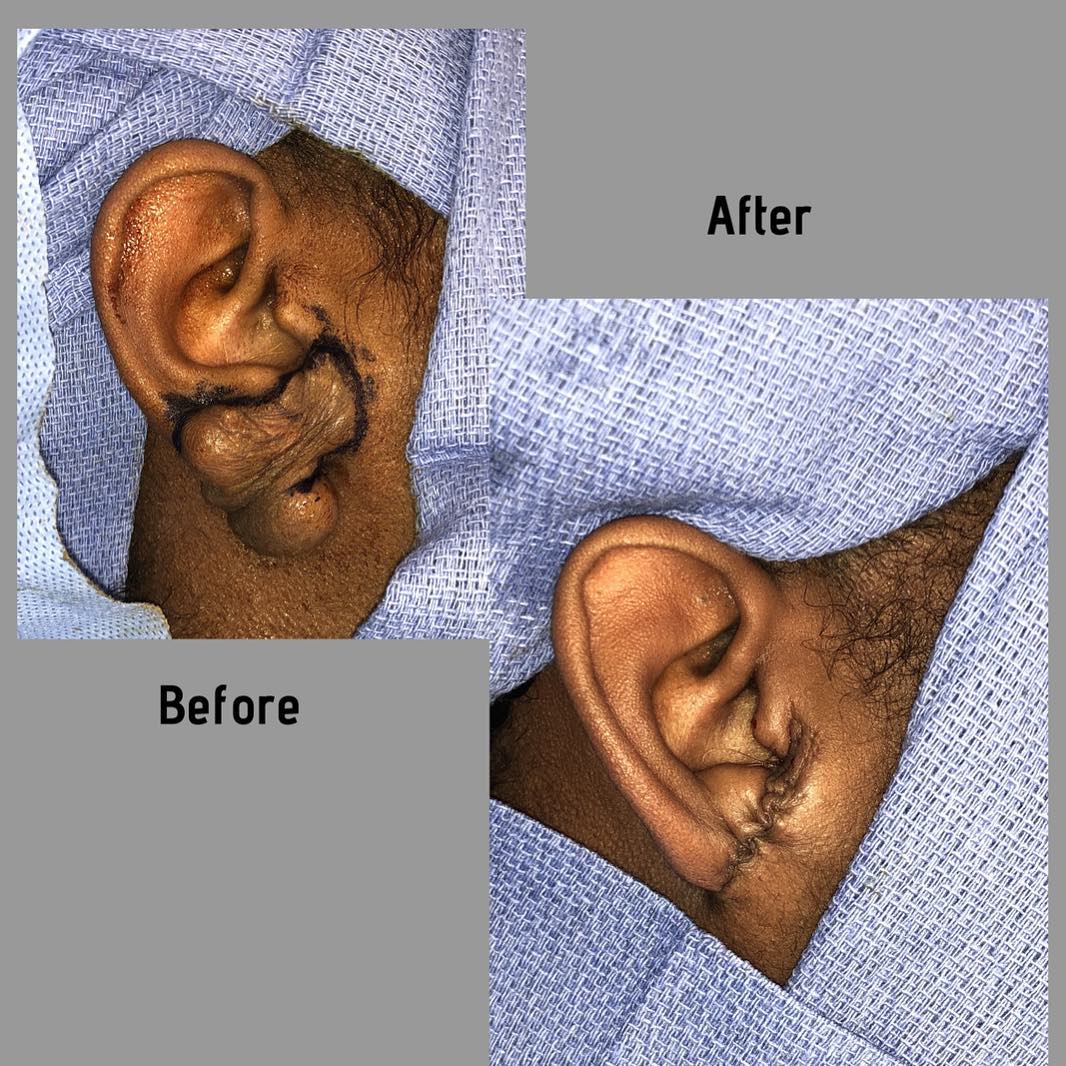 Instagram post by Dr. Frederick T. Work: Before & After: Ear reconstruction after removal of keloid. Patient was injected with PRP and will undergo post operative radiation therapy …