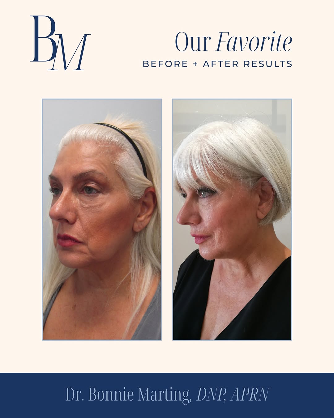 Instagram post by Dr. Fredric M. Barr: Some of Dr. Bonnie’s favorite transformations—each created with a thoughtful, individualized approach. From restoring natural-looking volume…