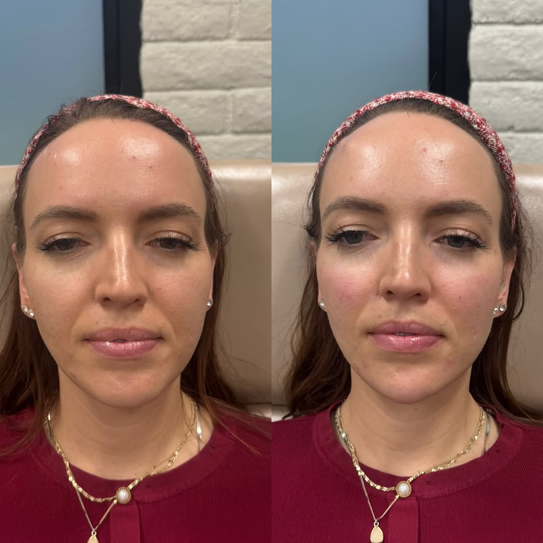 Instagram post by Dr. G. Robert Meger: Facial balancing ✨ — because it’s not always about adding volume, it’s about adding structure where it matters. This beauty received 4 syrin…