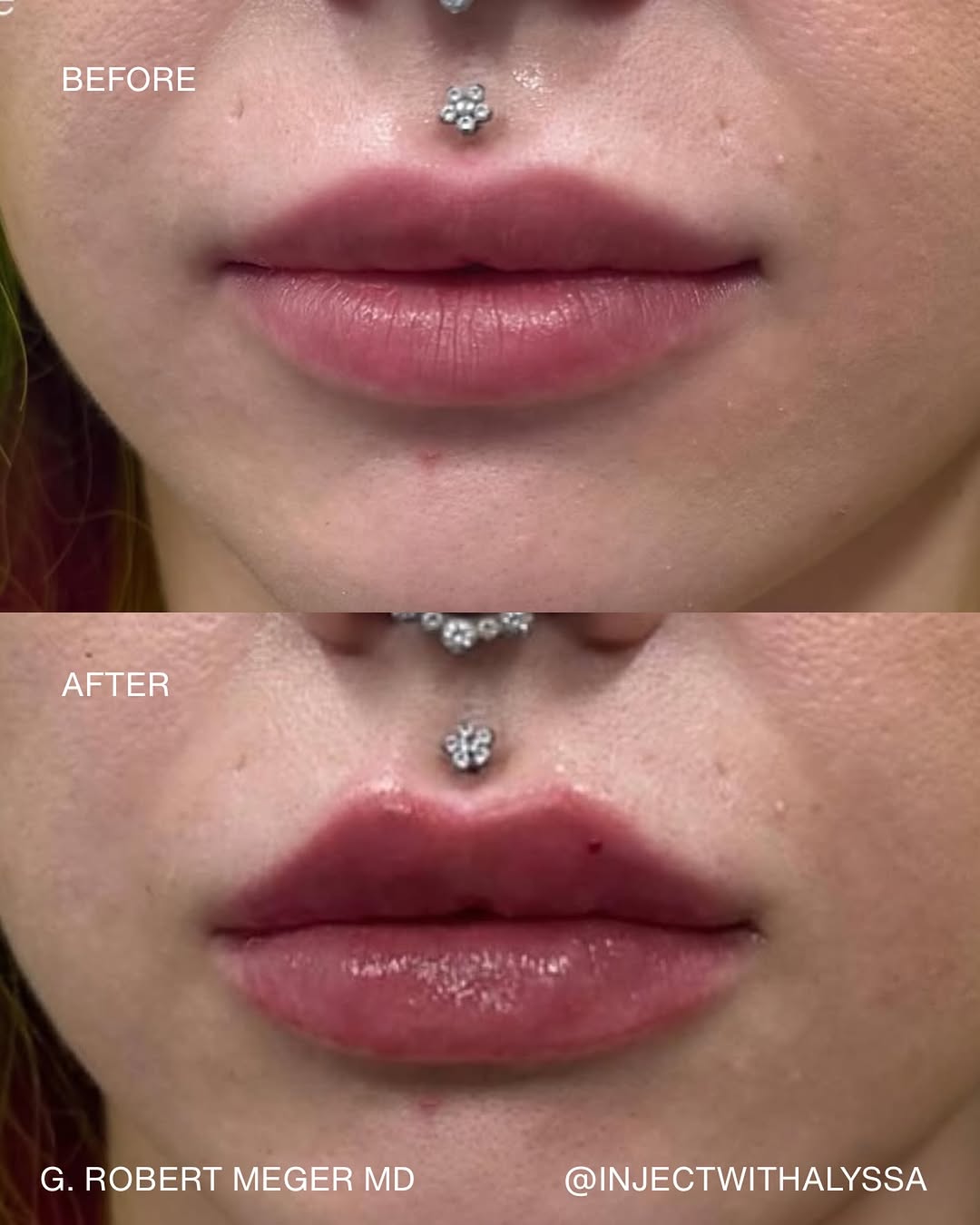 Instagram post by Dr. G. Robert Meger: Redefined her shape while keep her lips looking natural and youthful! #scottsdalelipfiller #arizonainjector #scottsdaleinjector #scottsdalel…