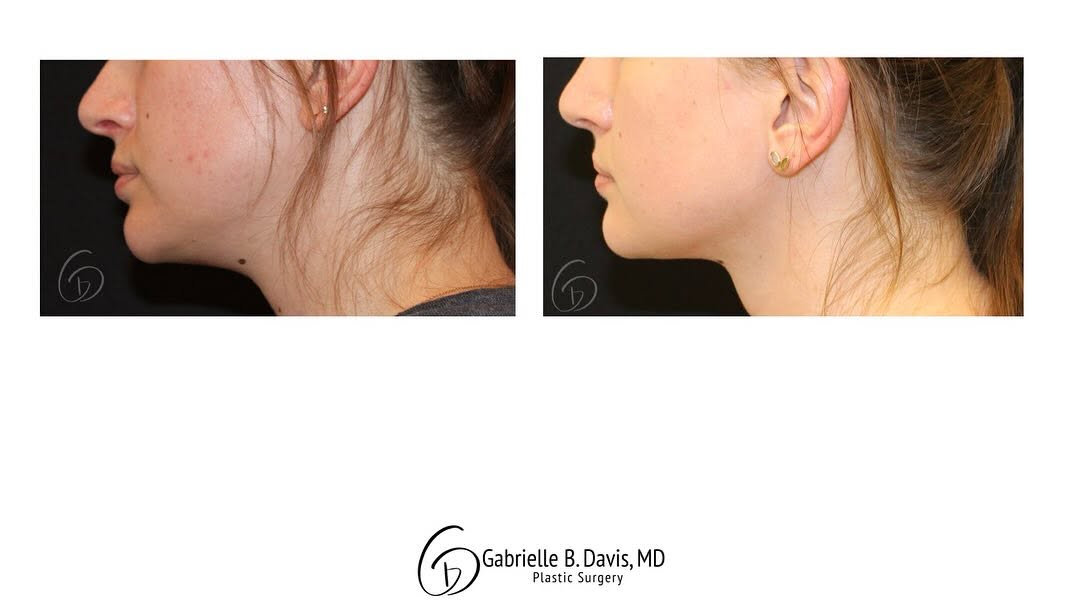 Instagram post by Dr. Gabrielle B. Davis: ✨ Real results. Real confidence. ✨ Meet one of our beautiful patients who took a step toward feeling her best — and we couldn't be more prou…