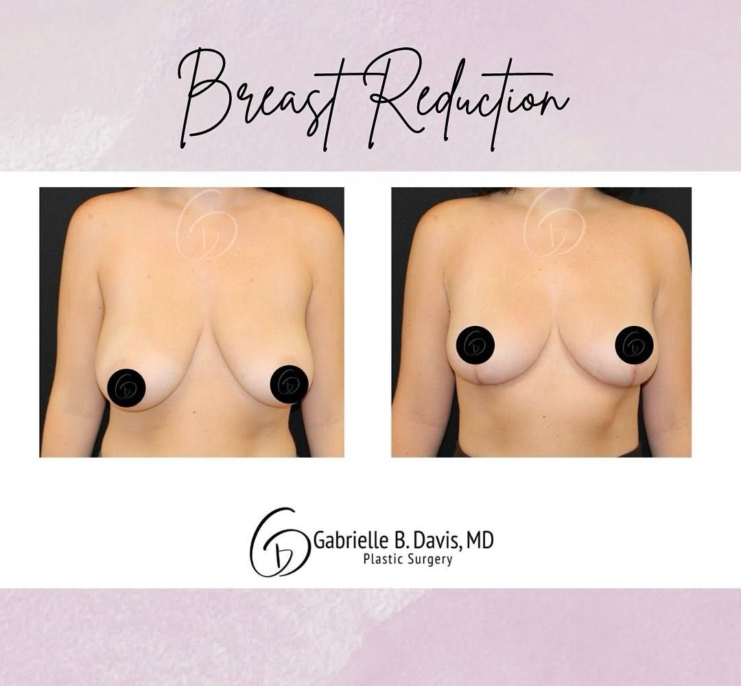 Instagram post by Dr. Gabrielle B. Davis: Breast Reduction Surgery Is About So Much More Than Appearance✨ For many patients, it can be truly life-changing- helping to relieve neck, b…