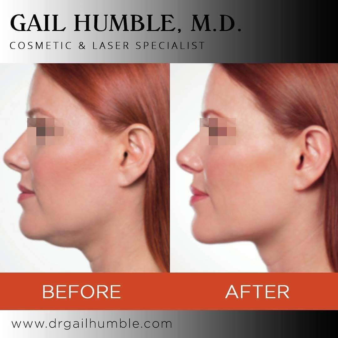 Instagram post by Dr. Gail Humble: Before and After Kybella Injections . . Kybella is an injectable composed of deoxycholic acid, purposed to destroy excess fat beneath the ch…