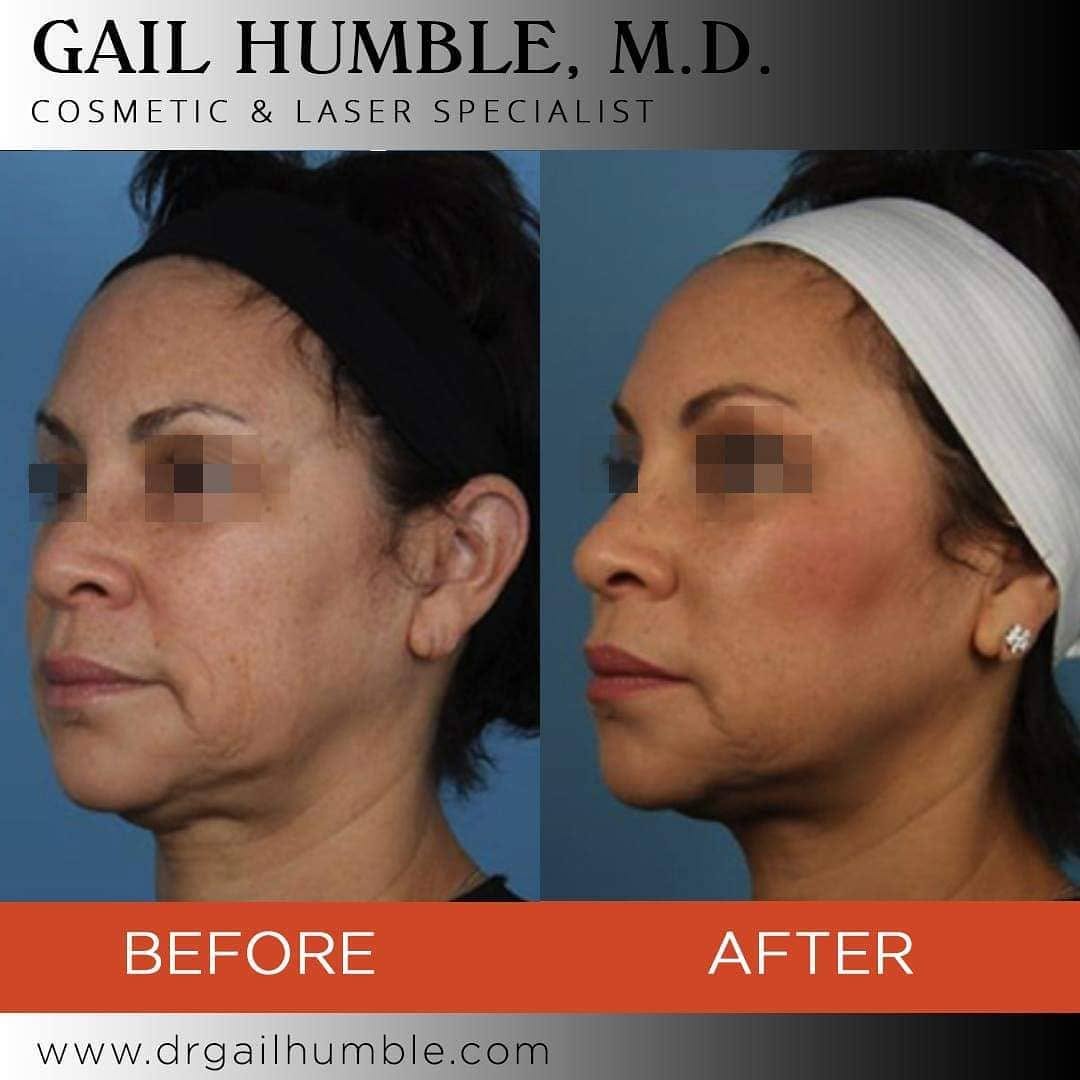 Instagram post by Dr. Gail Humble: Before And After Silhouette Instalift . . In just under an hour, Dr. Humble re-contours the face, lifting sagging features, to implement a m…