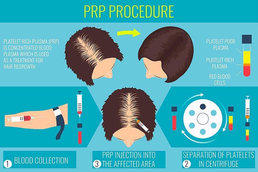 Instagram post by Dr. Gail Humble: There is power in the PRP! PRP stands for Platelet Rich Plasmsa, and in hair transplantation, PRP can be injected into the recipient site ar…