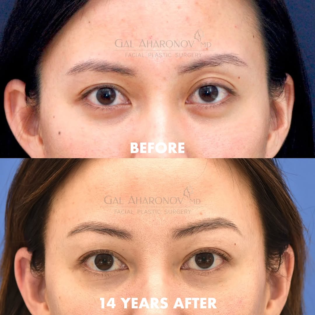 Instagram post by Dr. Gal Aharonov: 14 YEARS AFTER! Using HA filler in the upper eyelid to create better symmetry and fullness. Plastic surgery is full of trends. 2026 is the y…