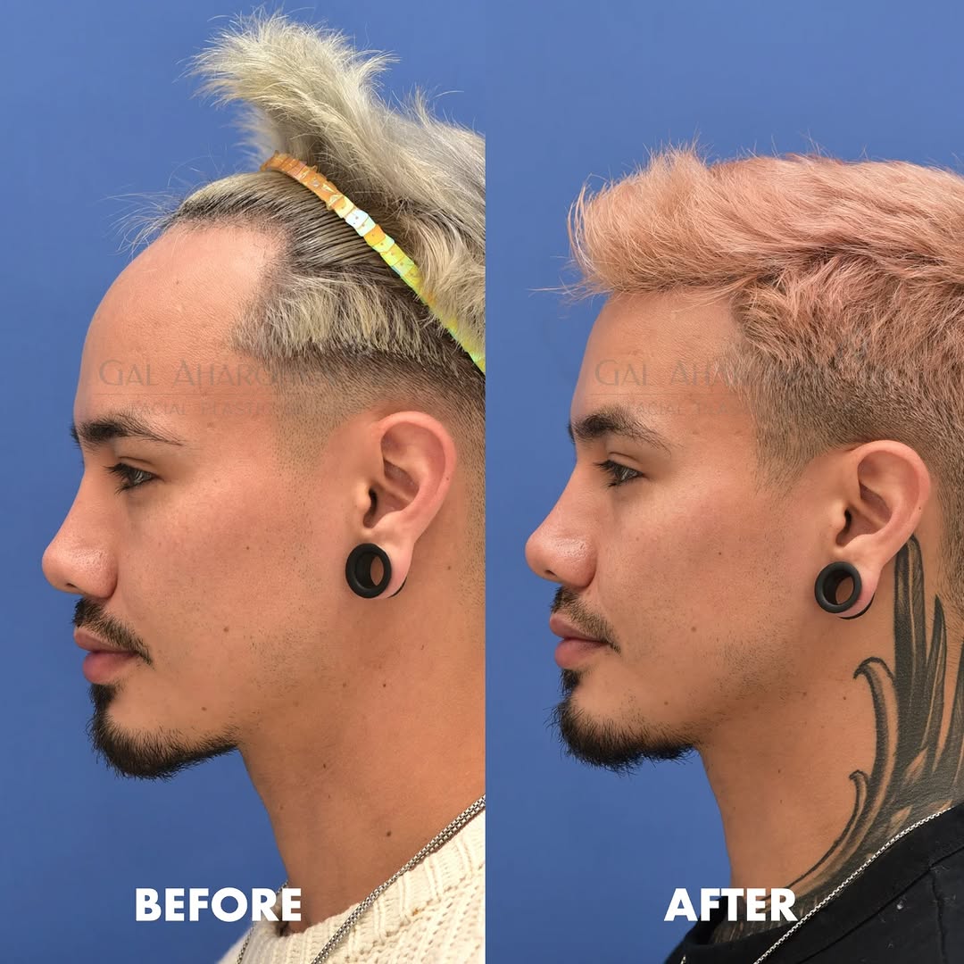 Instagram post by Dr. Gal Aharonov: This gentleman spent his entire life hiding his forehead with bangs. He has never worn his hair pulled back. He is now just 5 months after a…