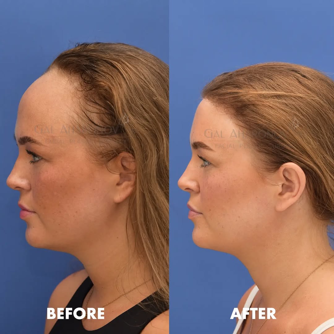 Instagram post by Dr. Gal Aharonov: This beautiful woman was born with a high hairline and low hair density. She was so bothered by her forehead that she always wore a wig, eve…