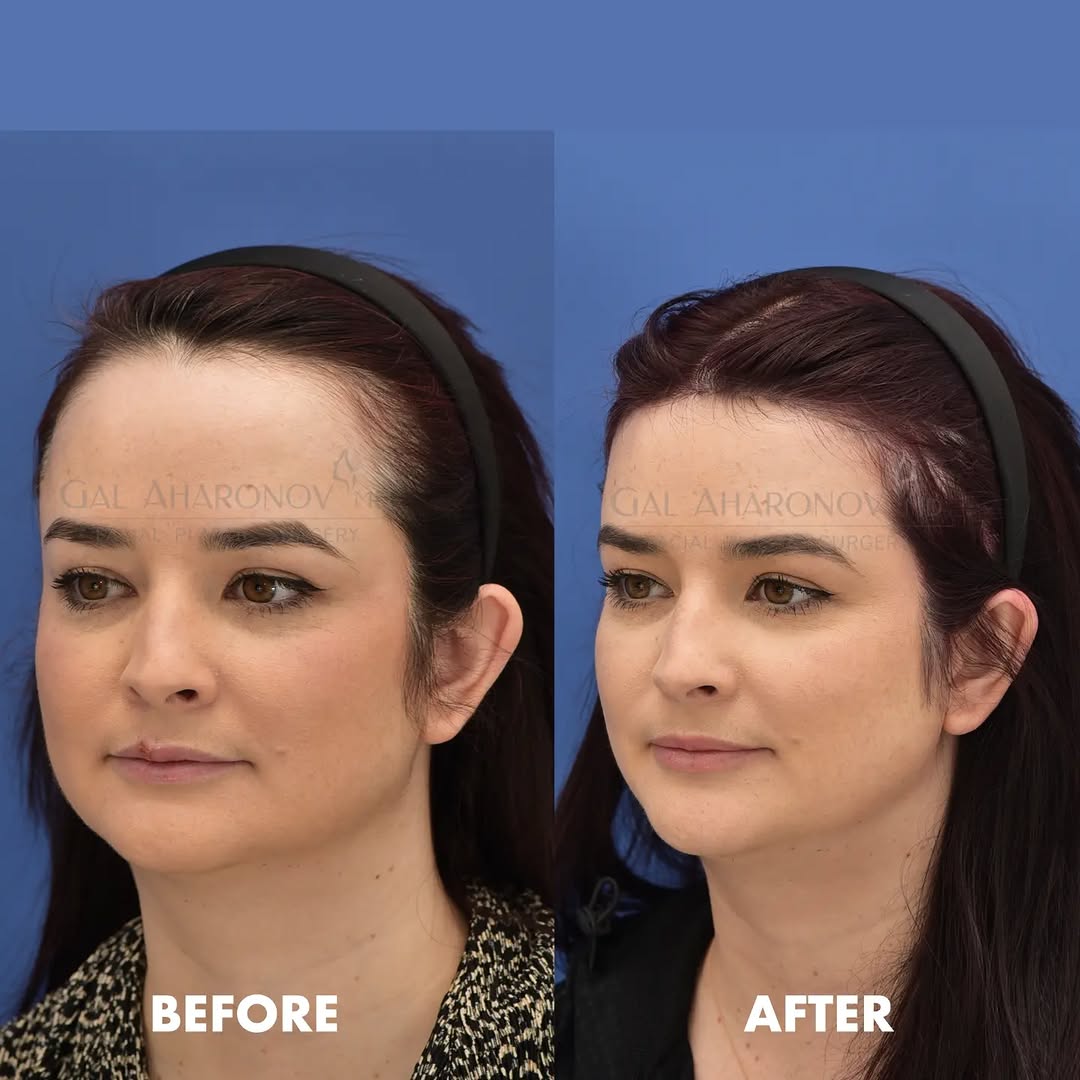 Instagram post by Dr. Gal Aharonov: This sweet young lady was bothered by her congenital high and asymmetric hairline. I performed a one stage hairline lowering surgery with re…