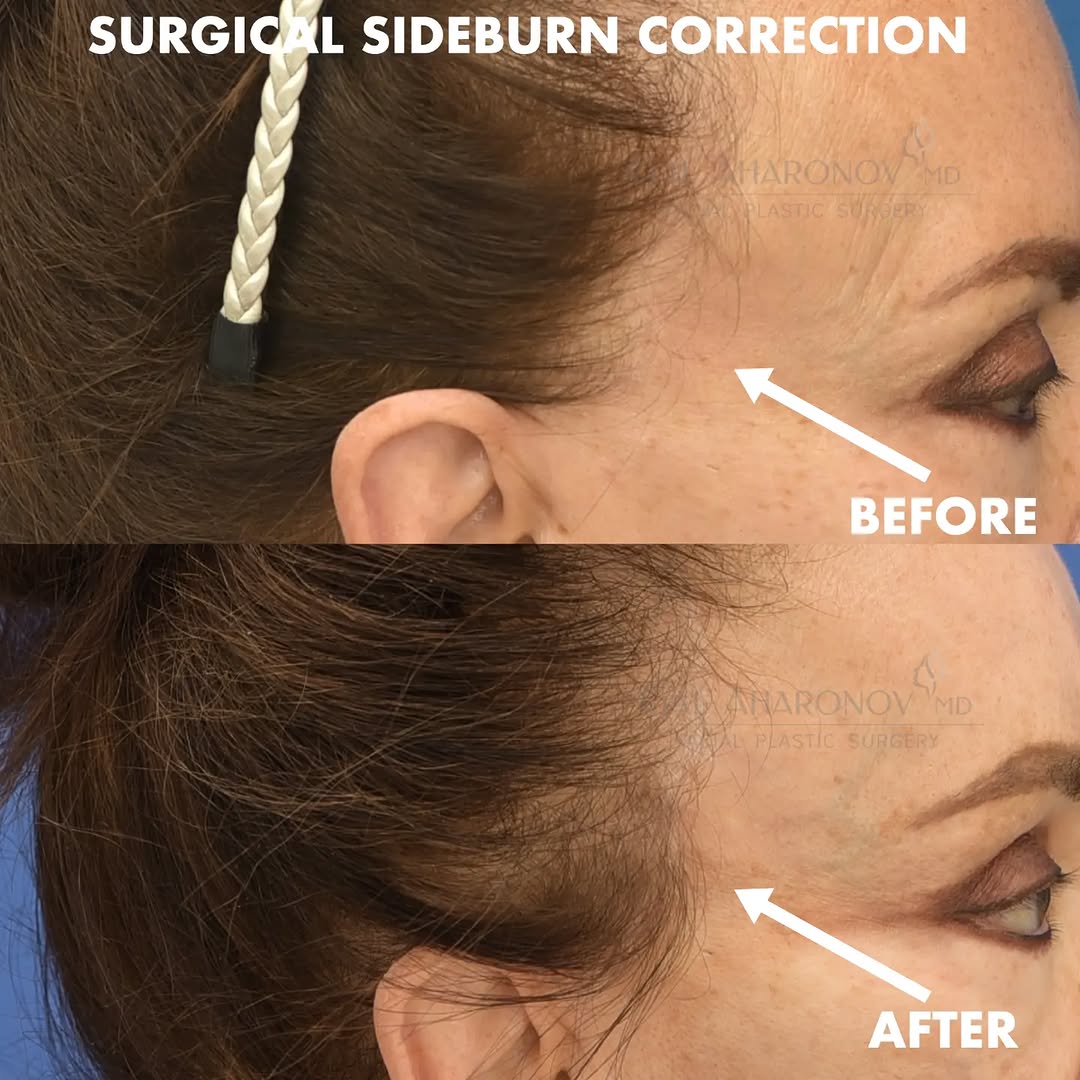 Instagram post by Dr. Gal Aharonov: This was a surgical correction of a sideburn that was pulled too high by a previous facelift performed by another surgeon. I repositioned th…