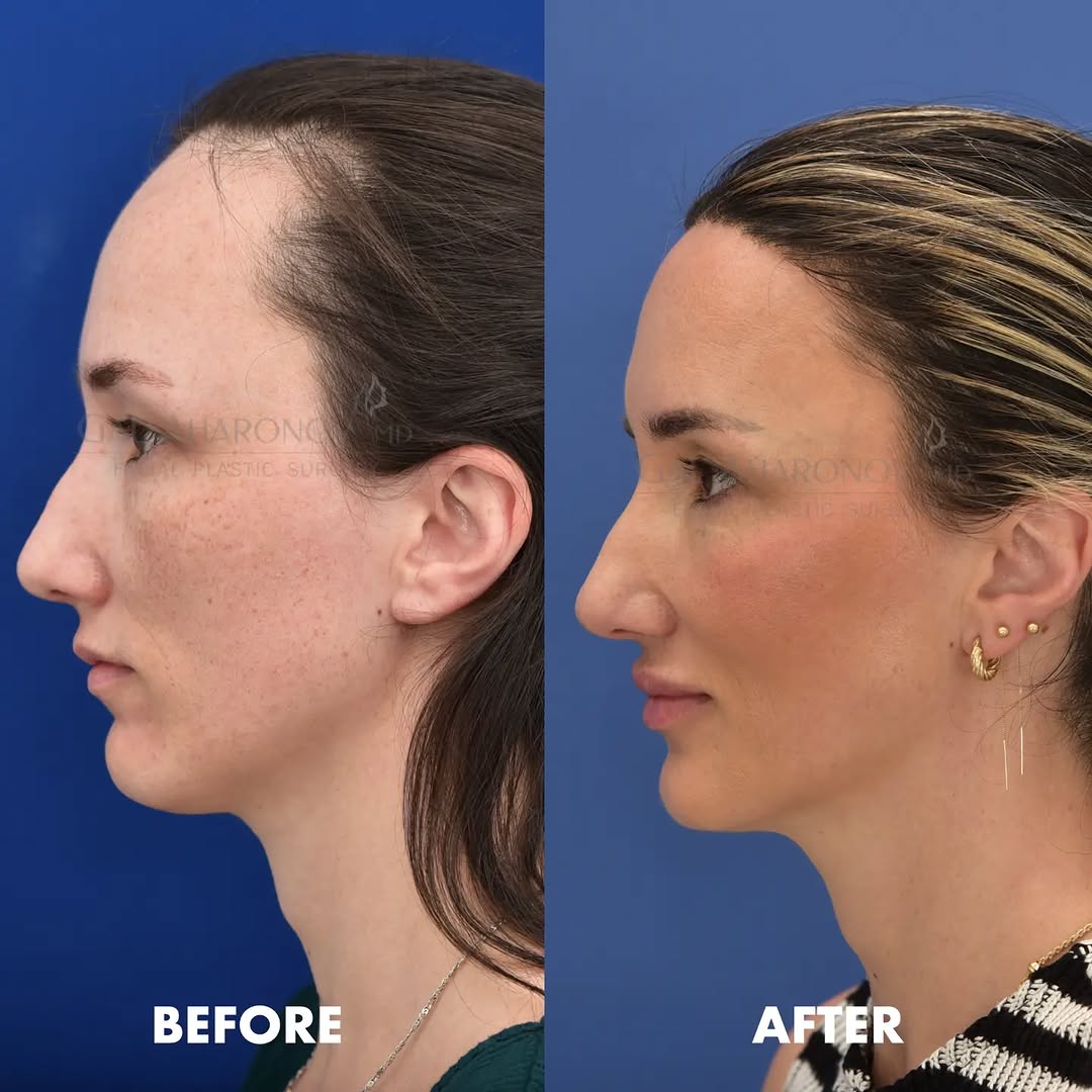 Instagram post by Dr. Gal Aharonov: This already beautiful woman was born with a hairline she felt was too high, too wide, and too thin. I performed a one stage surgery lowerin…