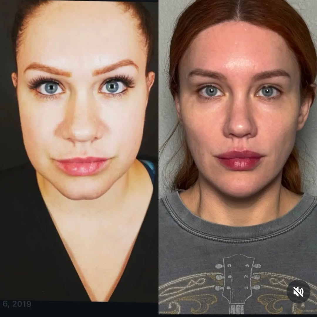 Instagram post by Dr. Gal Aharonov: My beautiful patient vulnerably sharing her own journey. Cosmetic treatments are not addicting. But unfortunately, looking better is. Hairli…
