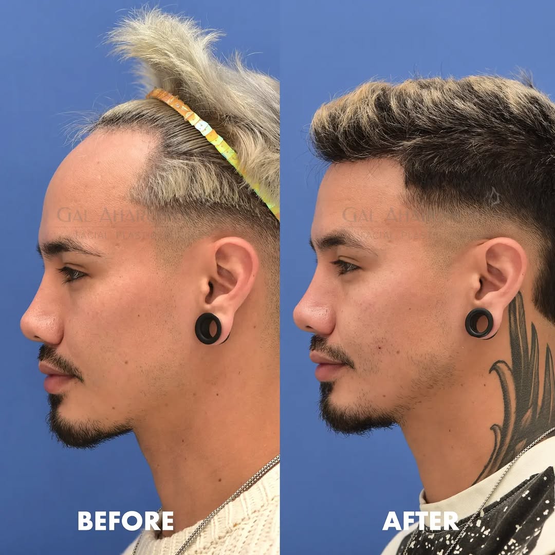 Instagram post by Dr. Gal Aharonov: Six month update for this dashing young gentleman. One stage hairline lowering using our FROST surgery. #foreheadreduction #hairrestoration …