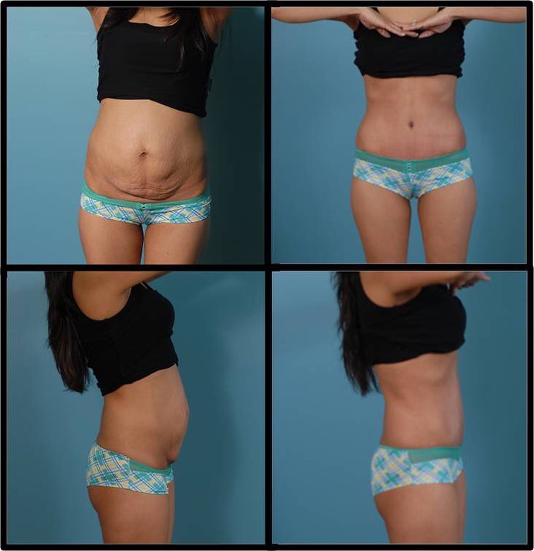 Instagram post by Dr. Garey Simmonds: Check out our before and after results of a Tummy Tuck Dr. Simmonds performed!! _______________________________________________________ **Re…