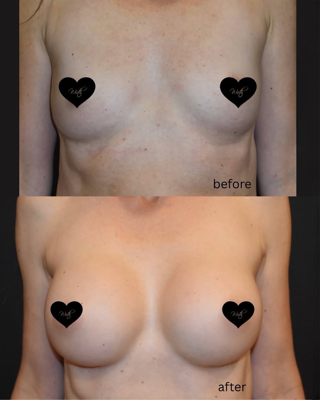 Instagram post by Dr. Garrett A. Wirth: One year post-op and beautifully settled. ✨ At the one-year mark following breast augmentation, we’re able to appreciate how the implants ha…