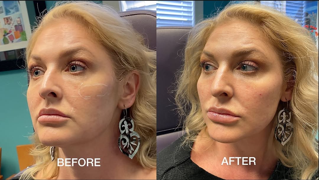 Instagram post by Dr. Garrett M. Crabtree: Cheek Augmentation before and after with #Radiesse filler! #louisville #dermal #filler #injection #drcrabtree