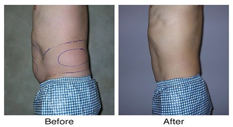 Instagram post by Dr. Garrett M. Crabtree: Before and After of male abdomen. Call us for a FREE consultation! #louisville #lipo #liposuction #abs #beforeandafter