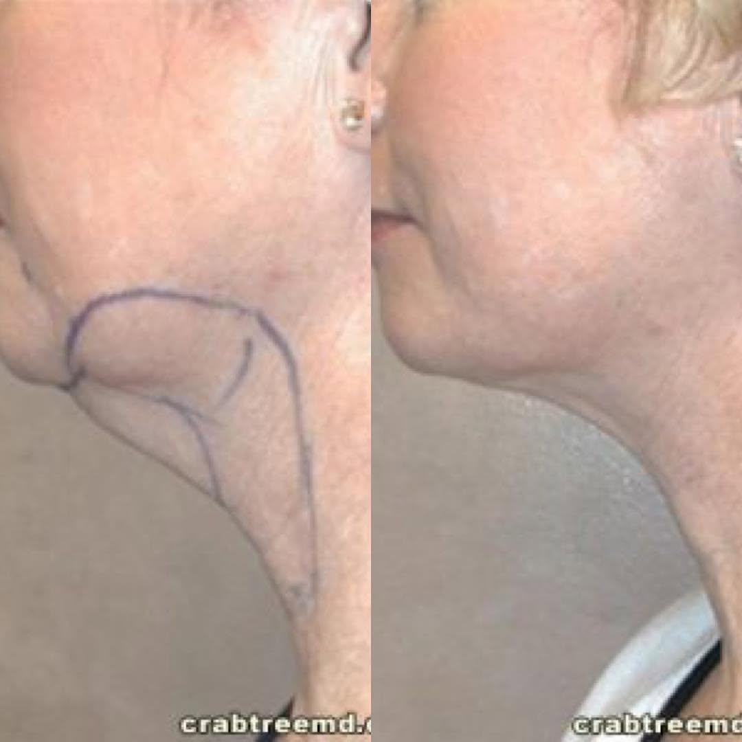 Instagram post by Dr. Garrett M. Crabtree: #beforeandafter of tumescent liposuction on female neck. Neck Liposuction often yields excellent results! Call for a free consultation with …