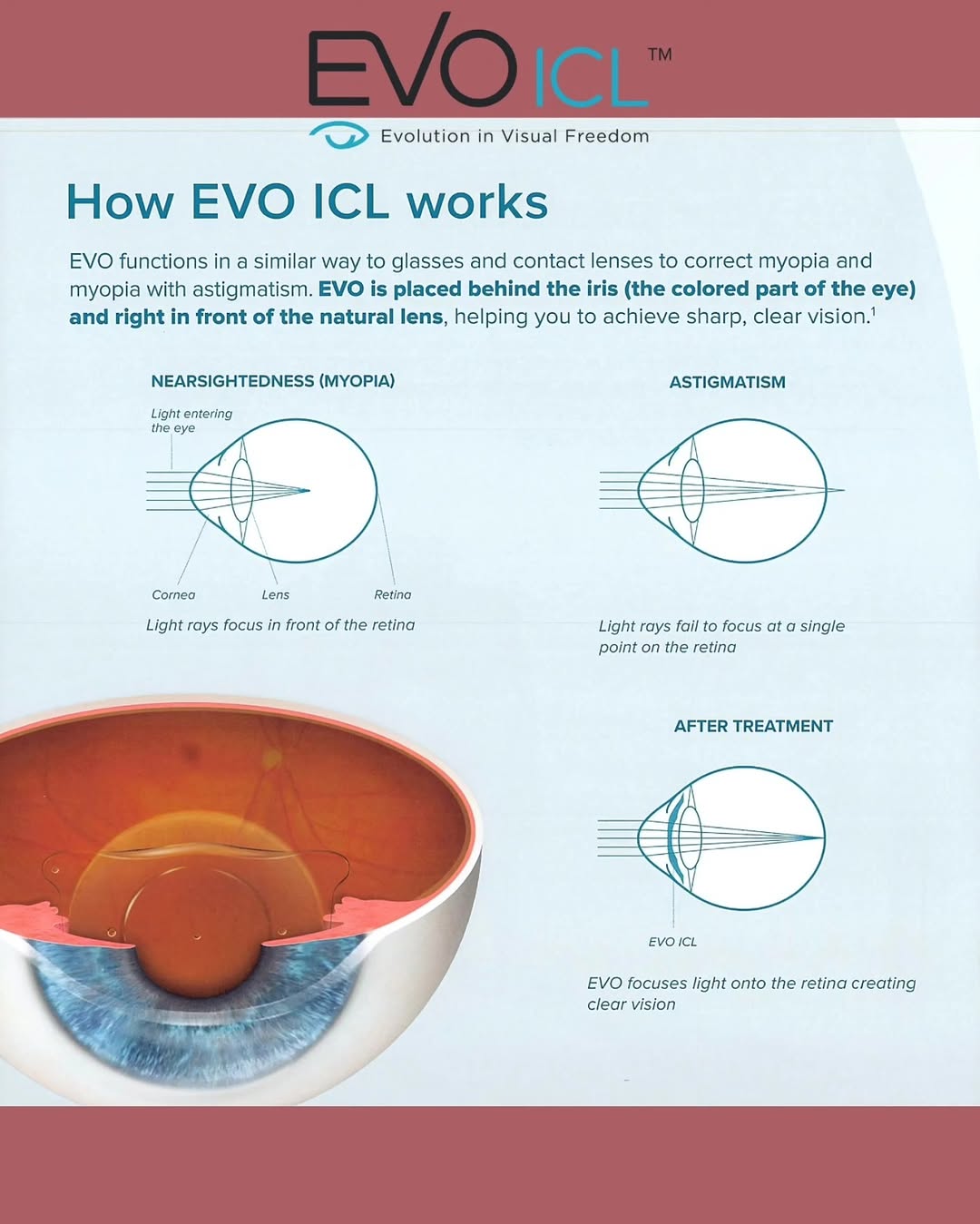 Instagram post by Dr. Gary L. Aguilar: For those not ready for LASIK, EVO ICL is a game-changer! Permanent vision correction without removing any corneal tissue. DM us to see if i…