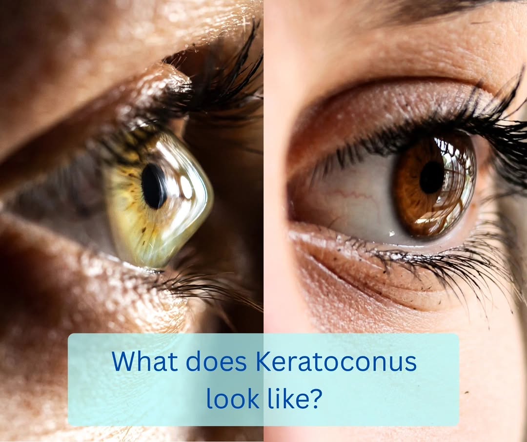 Instagram post by Dr. Gary L. Aguilar: Keratoconus is a progressive eye condition that affects the cornea in which the normally rounded cornea bulges outward into a cone shape. As…
