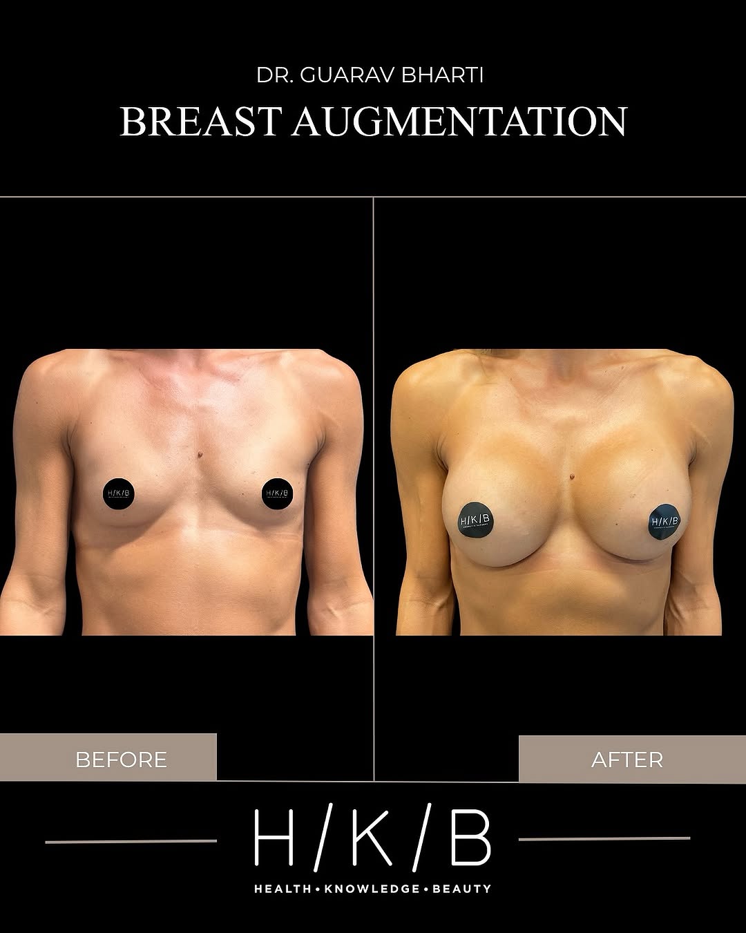 Instagram post by Dr. Gaurav Bharti: ✨ Fit. Feminine. Balanced. ✨ This very fit mom wanted to restore breast volume while maintaining a natural, athletic silhouette. We performe…