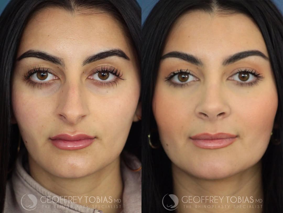 Instagram post by Dr. Geoffrey W. Tobias: A closed scarless rhinoplasty by Dr. Tobias can improve facial balance and transform your face💥 How incredible does our patient look? 🤍 • …