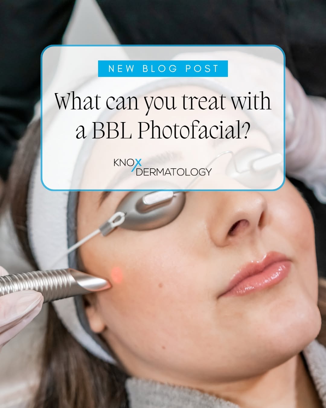 Instagram post by Dr. George A. Wooming: Think BBL treatments are just for your face? Think again. BroadBand Light (BBL) technology can address sun damage, redness, pigmentation, ac…
