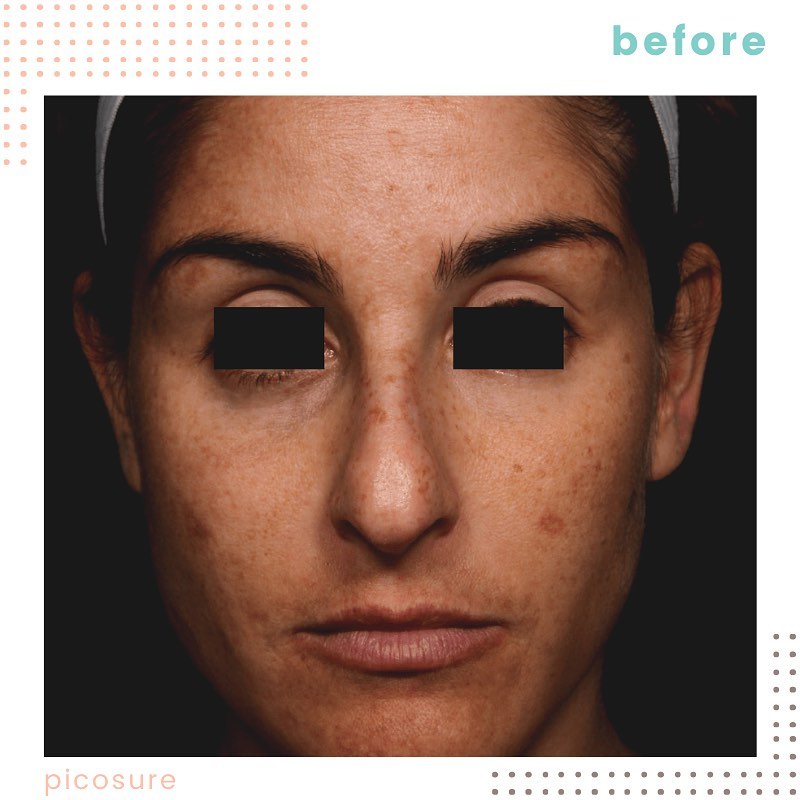 Instagram post by Dr. George Anterasian: 🏆 PicoSure is the perfect treatment for pigment, wrinkles, and acne scars when you have no time for downtime. ••••• 😍☎️ (310) 589-3695 ✉️ …