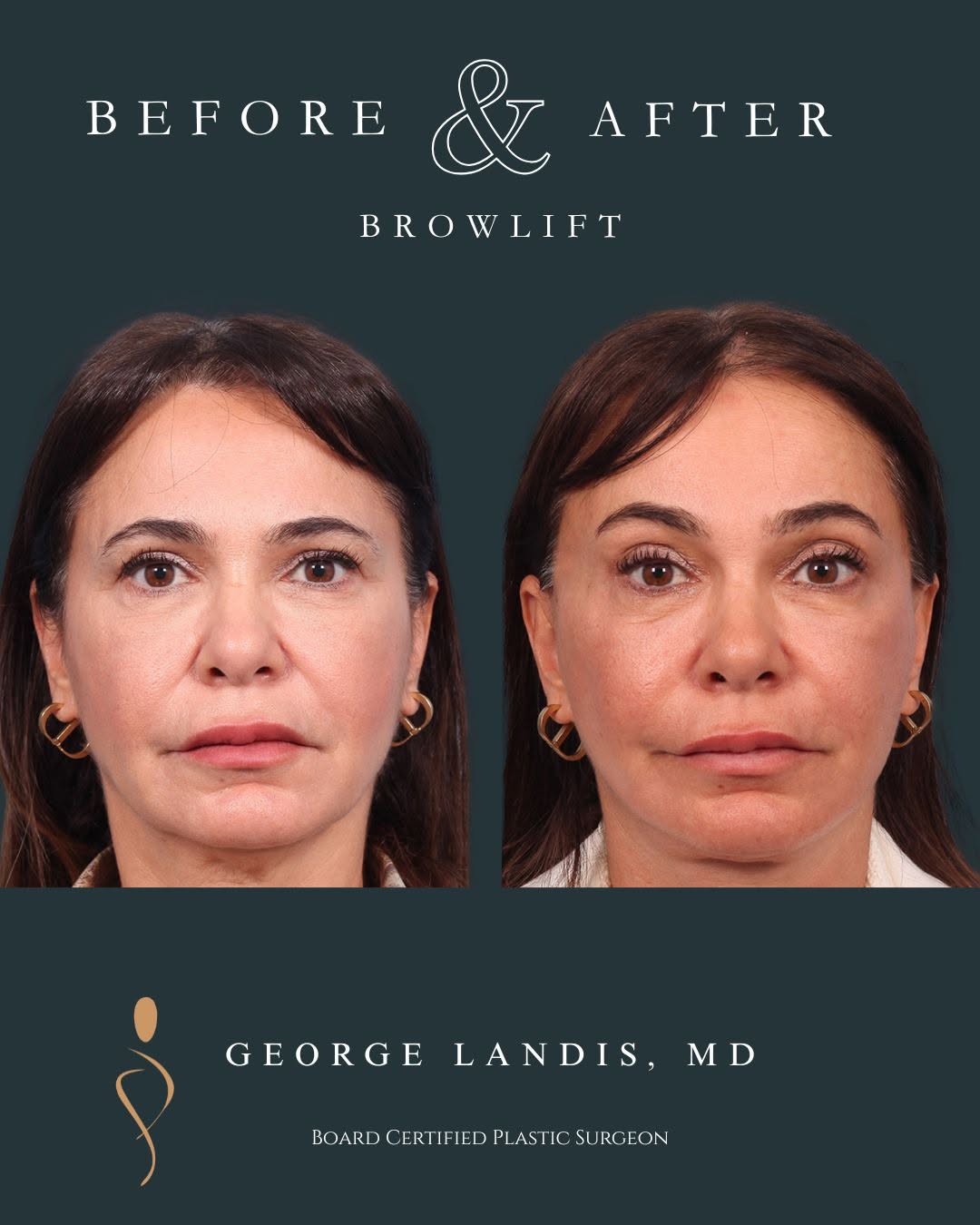 Instagram post by Dr. George H. Landis: ✨ **Refreshed. Rested. Naturally her.** ✨ This 55‑year‑old patient wanted to look as vibrant as she feels—and after her brow lift, the resul…