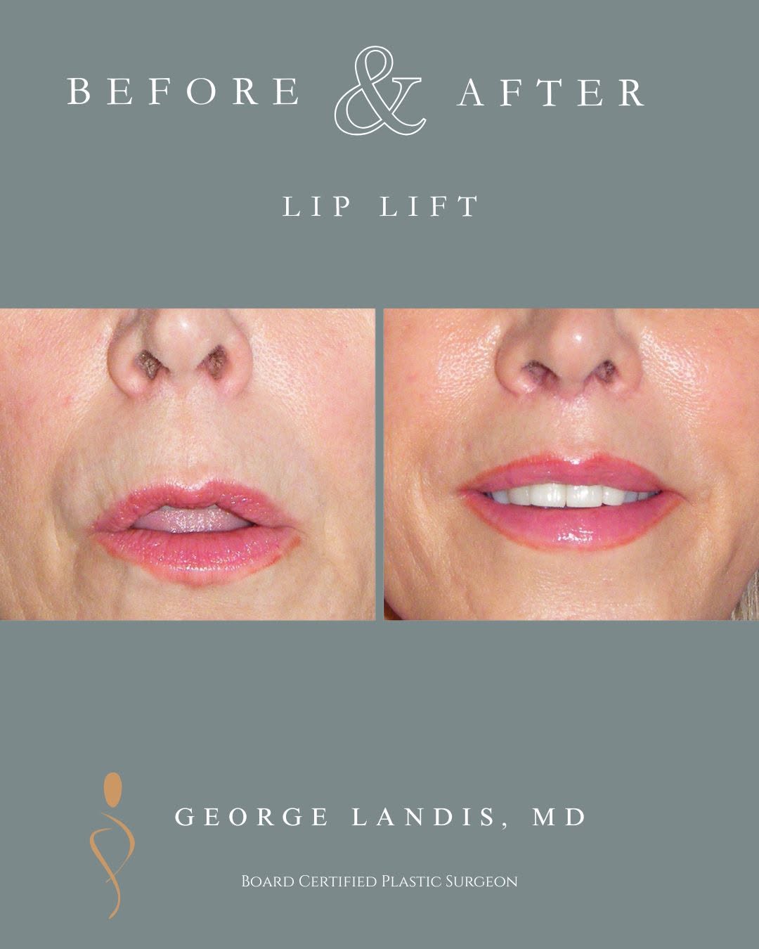 Instagram post by Dr. George H. Landis: ✨ Small change. Big difference. Naturally youthful. ✨ As we age, the upper lip naturally lengthens, which can make the smile look thinner an…