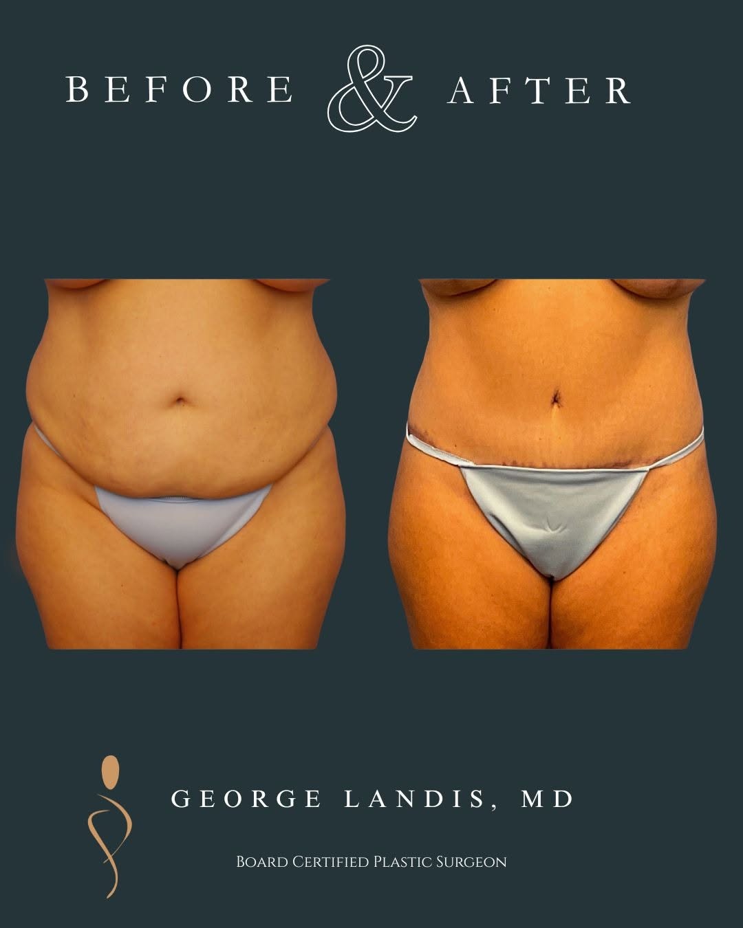 Instagram post by Dr. George H. Landis: ✨ **Real Results. Real Confidence.** ✨ After her tummy tuck, this 48‑year‑old patient experienced changes that went far beyond appearance: ✔…