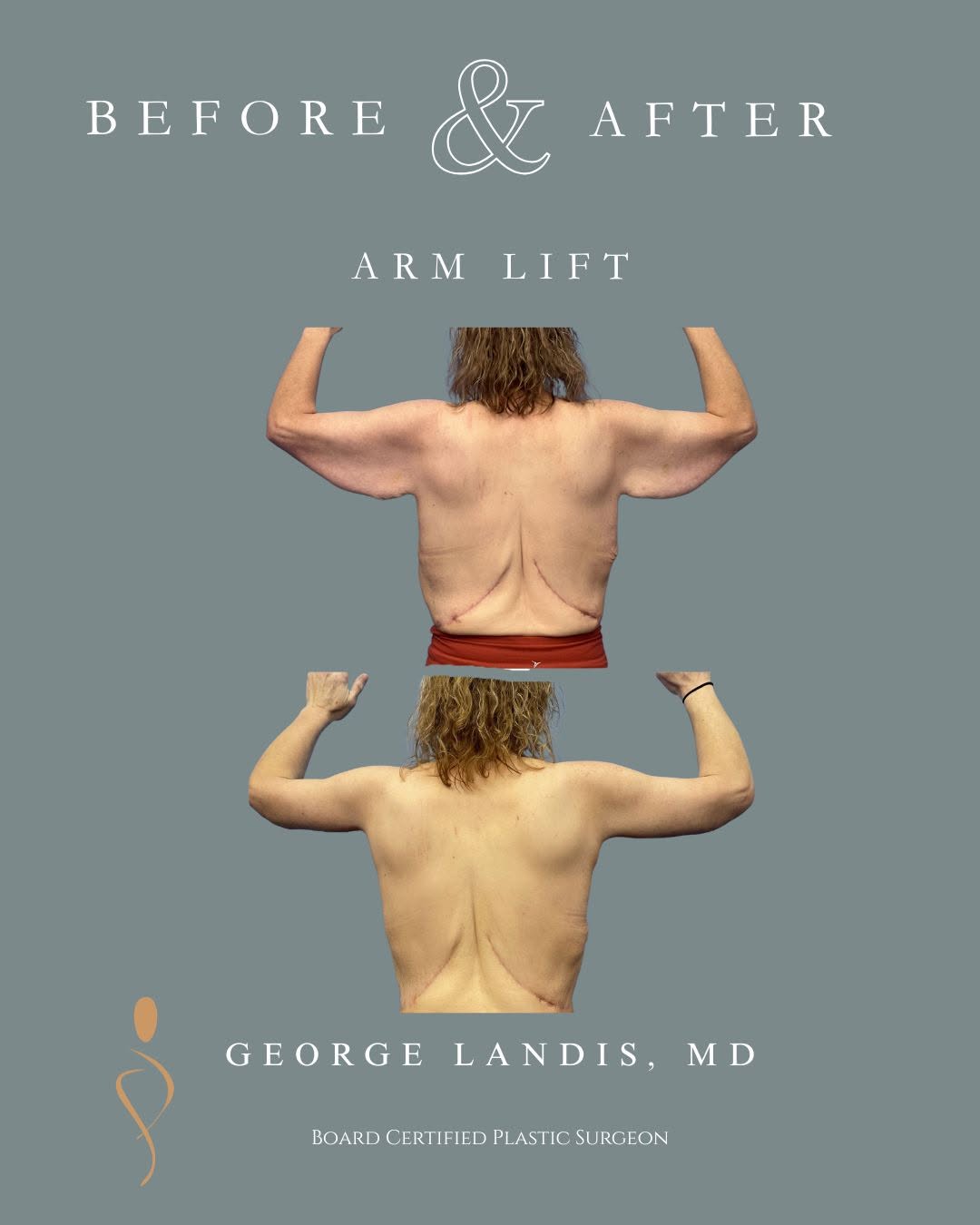 Instagram post by Dr. George H. Landis: 💪 **Strength, Freedom, Confidence** 💪 After an incredible **150+ lb weight loss**, this patient transformed her health—and her life. While…