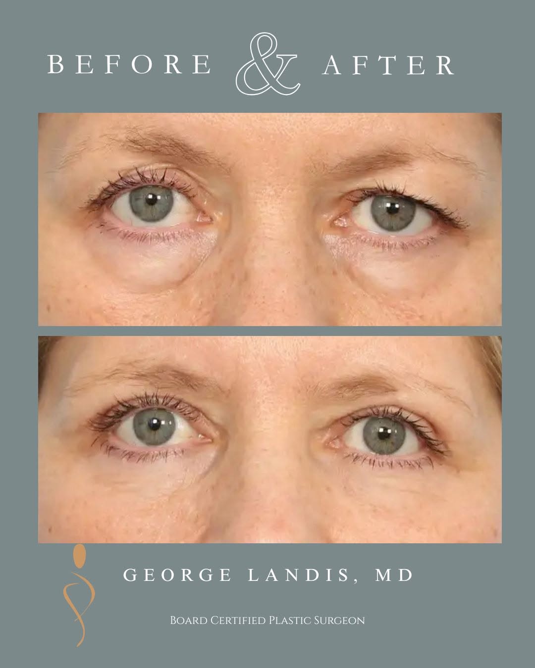 Instagram post by Dr. George H. Landis: Here's a patient-friendly, eighth-grade-level rewrite that is clear, engaging, and appropriate for a plastic surgery website: This patient w…