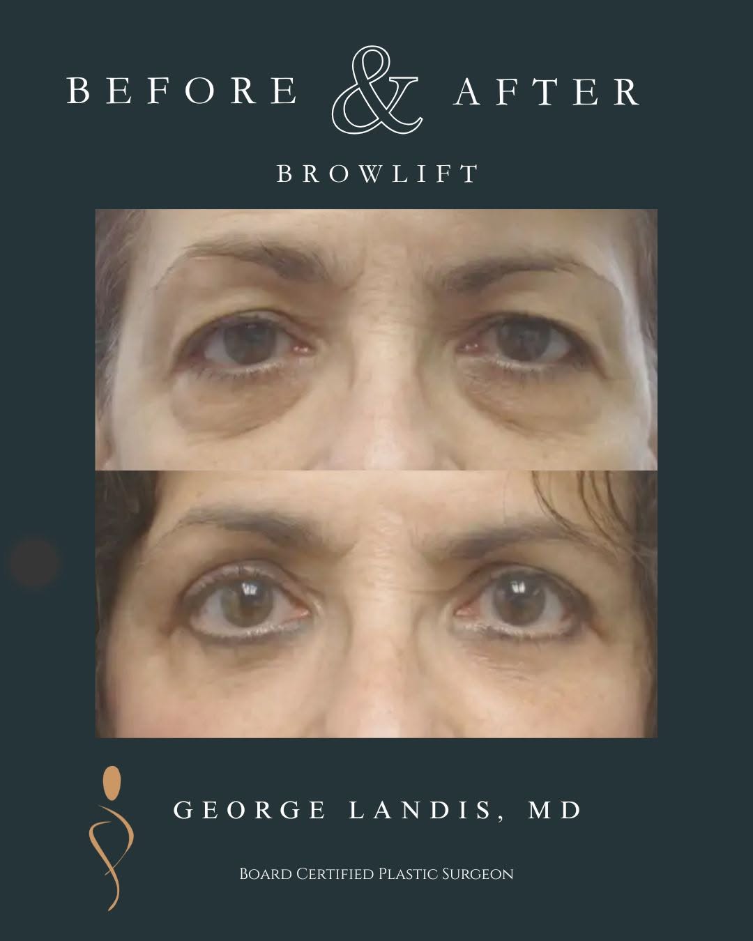 Instagram post by Dr. George H. Landis: ✨ A refreshed look can make a big difference! This 59-year-old patient underwent upper and lower eyelid surgery (blepharoplasty) to address …