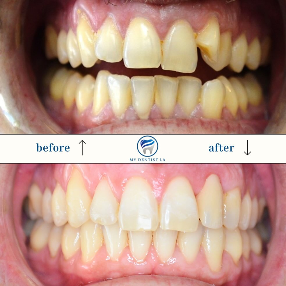 Instagram post by Dr. George Sahakyan: Case #65 before & after Invisalign + Porcelain veneer on tooth # 7. Finish in 14 months !! Don’t forget to book your dental visit for a radi…