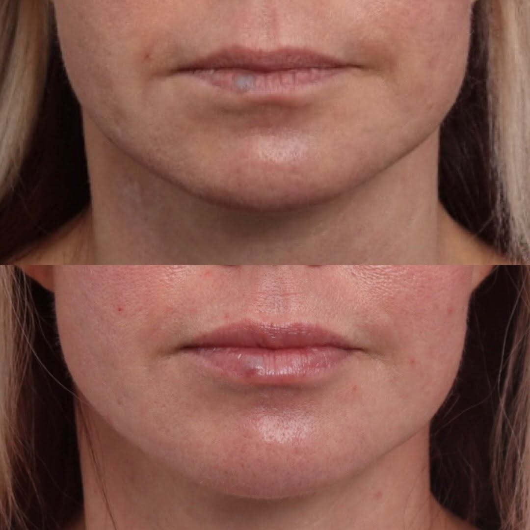 Instagram post by Dr. George T. Moynihan: Volume loss doesn’t just happen inside the lips—it also happens in the surrounding perioral area, where support and definition naturally dim…