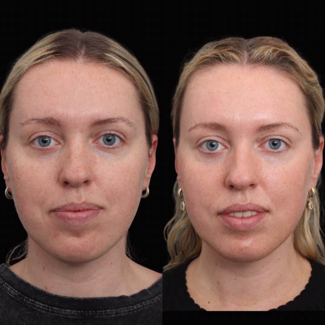 Instagram post by Dr. George T. Moynihan: This patient is 2 treatments into her BBL + MOXI journey, and we’re already seeing beautiful improvements in overall skin quality—more even …