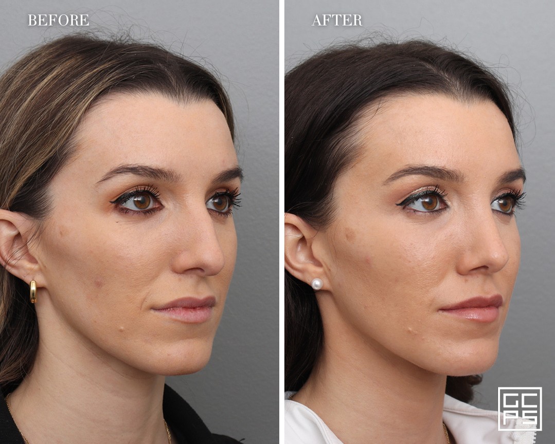 Instagram post by Dr. George T. Moynihan: Refined, balanced, and unmistakably her. Book your rhinoplasty consultation today by giving us a call at (312) 663-8632. #chicagorhinoplasty…