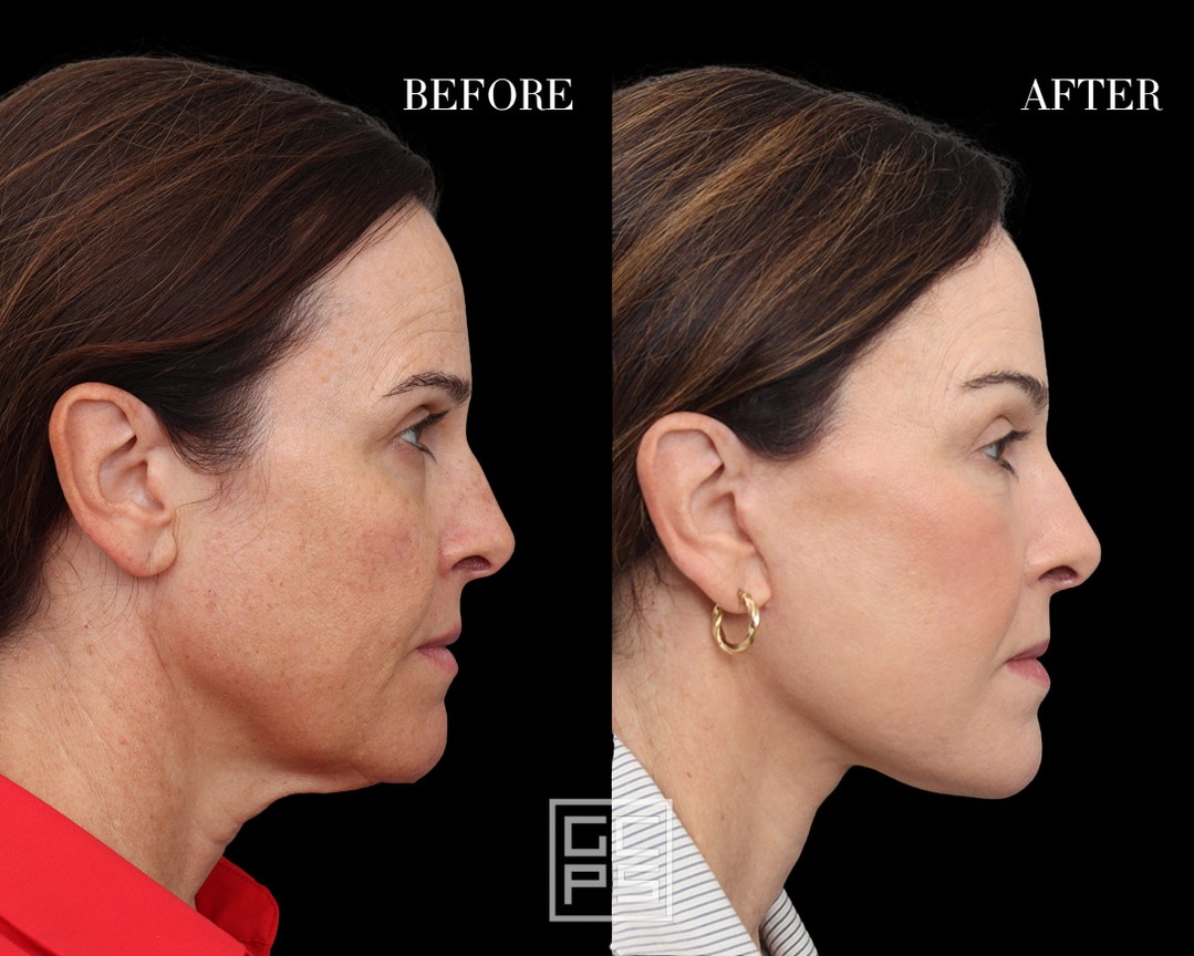 Instagram post by Dr. George T. Moynihan: At 6 months post-op, this patient's transformation says it all. Dr. Moynihan performed a deep plane face and neck lift alongside a browlift …