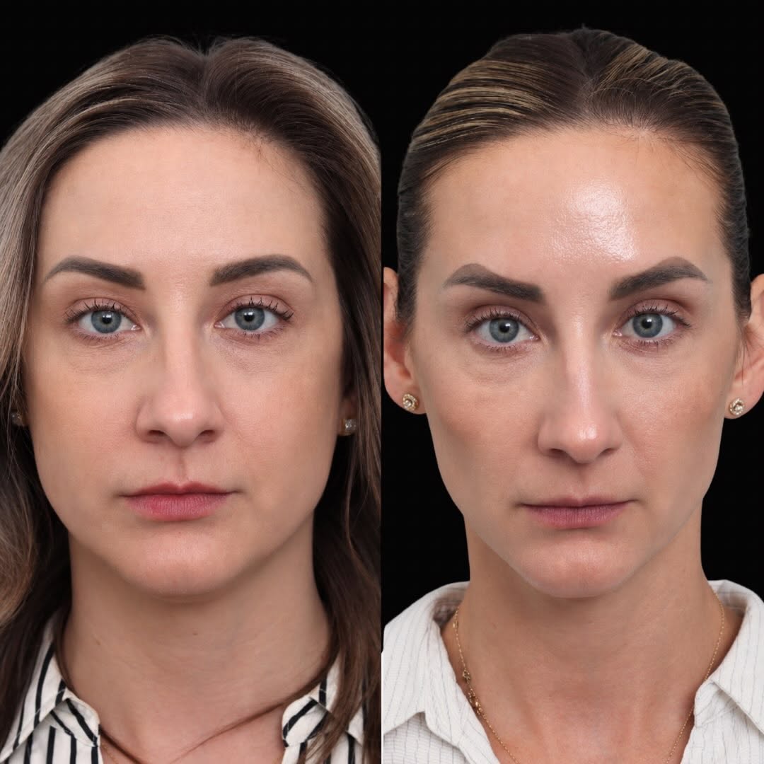 Instagram post by Dr. George T. Moynihan: These photos are 2.5 years apart! This is what a comprehensive, long-term aesthetic plan can look like. Over the past 2.5 years, we’ve focus…