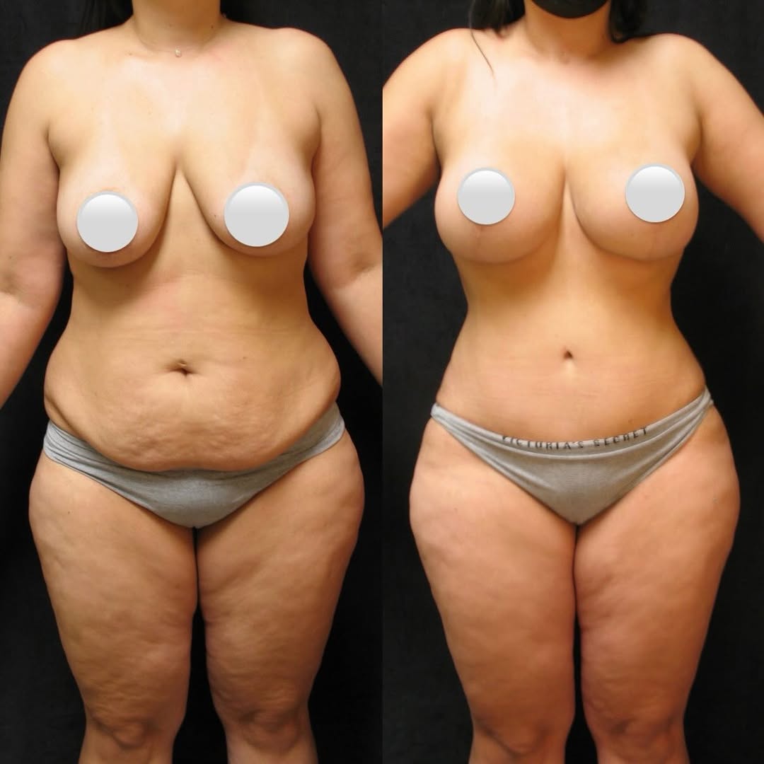 Instagram post by Dr. George Volpe: Mommy makeover by Dr. Volpe ✨ A stunning transformation featuring: 🤍 Abdominoplasty 🤍 Breast lift 🤍 Breast implants #MommyMakeover #Bosto…