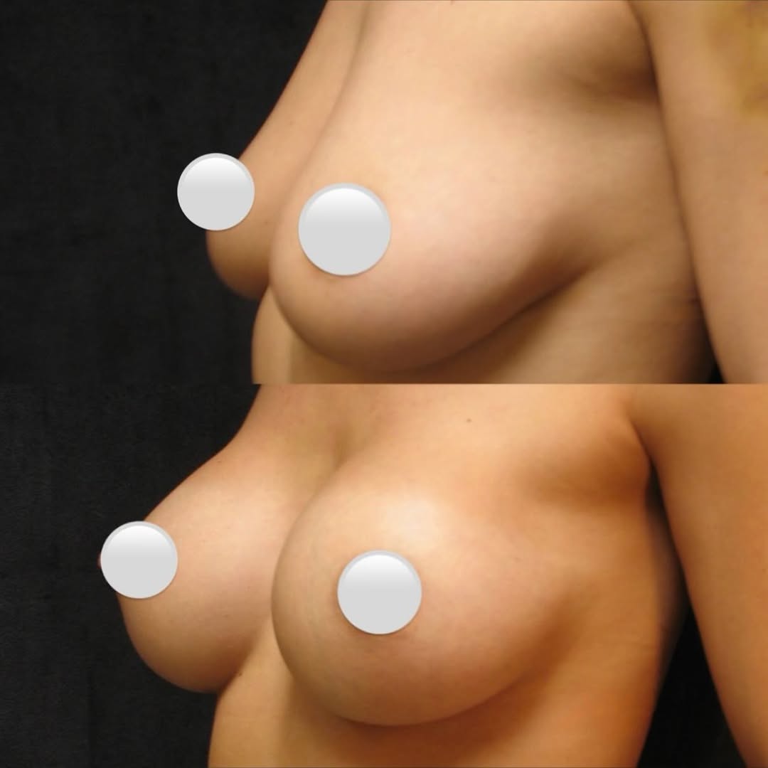 Instagram post by Dr. George Volpe: Breast Augmentation by Dr. Volpe! #BreastAugmentation #MentorImplants #BostonPlasticSurgery #PlasticSurgery