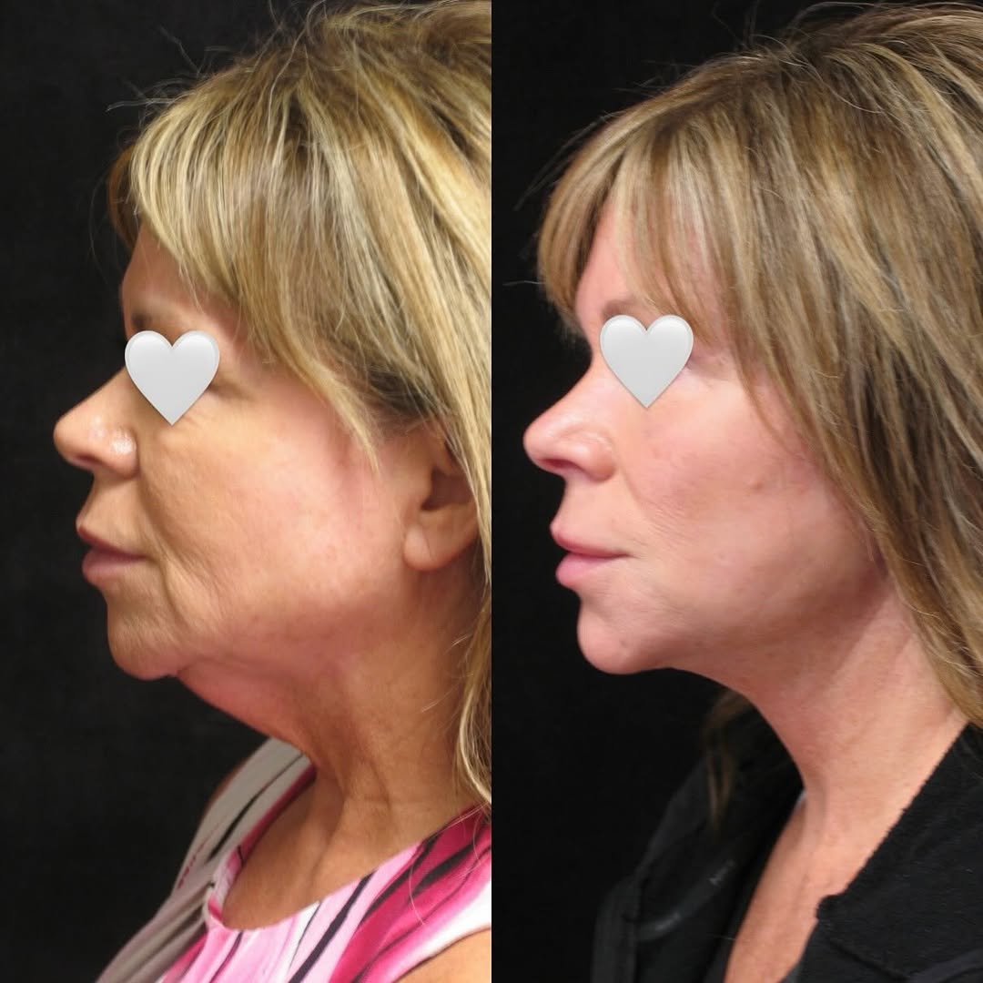 Instagram post by Dr. George Volpe: Facelift with Dr. Volpe! 🤩 #Facelift #Necklift #BostonPlasticSurgery #DrVolpe